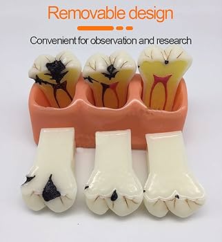 Amazon.co.jp: 取り外し可能歯列模型 齲蝕歯型模型 樹脂素材 歯