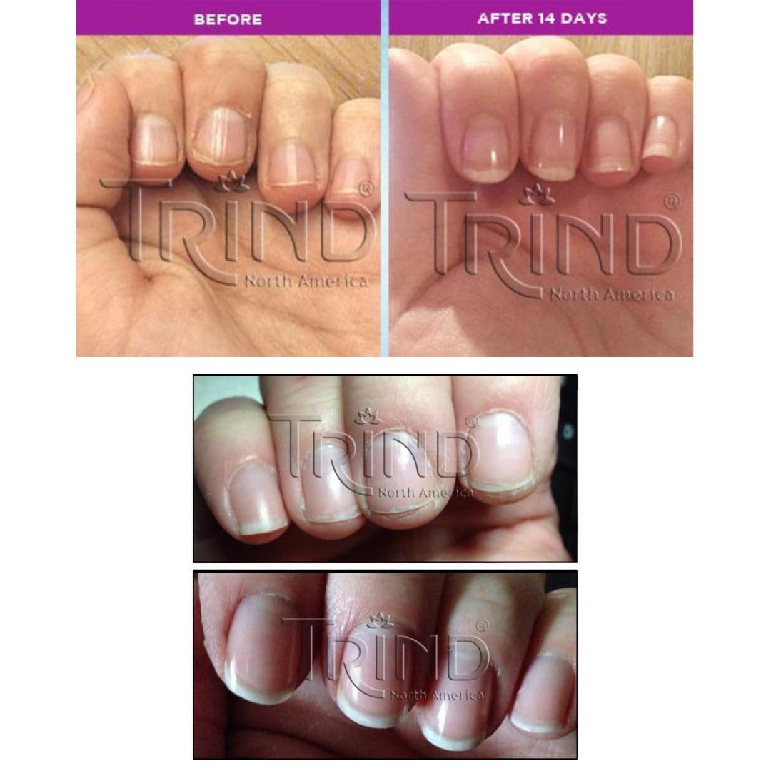 TRIND | Balsamo Rinforzante alla Cheratina | Unghie Sensibili e Danneggiate | Ripara, Protegge, Idrata 1x9ml