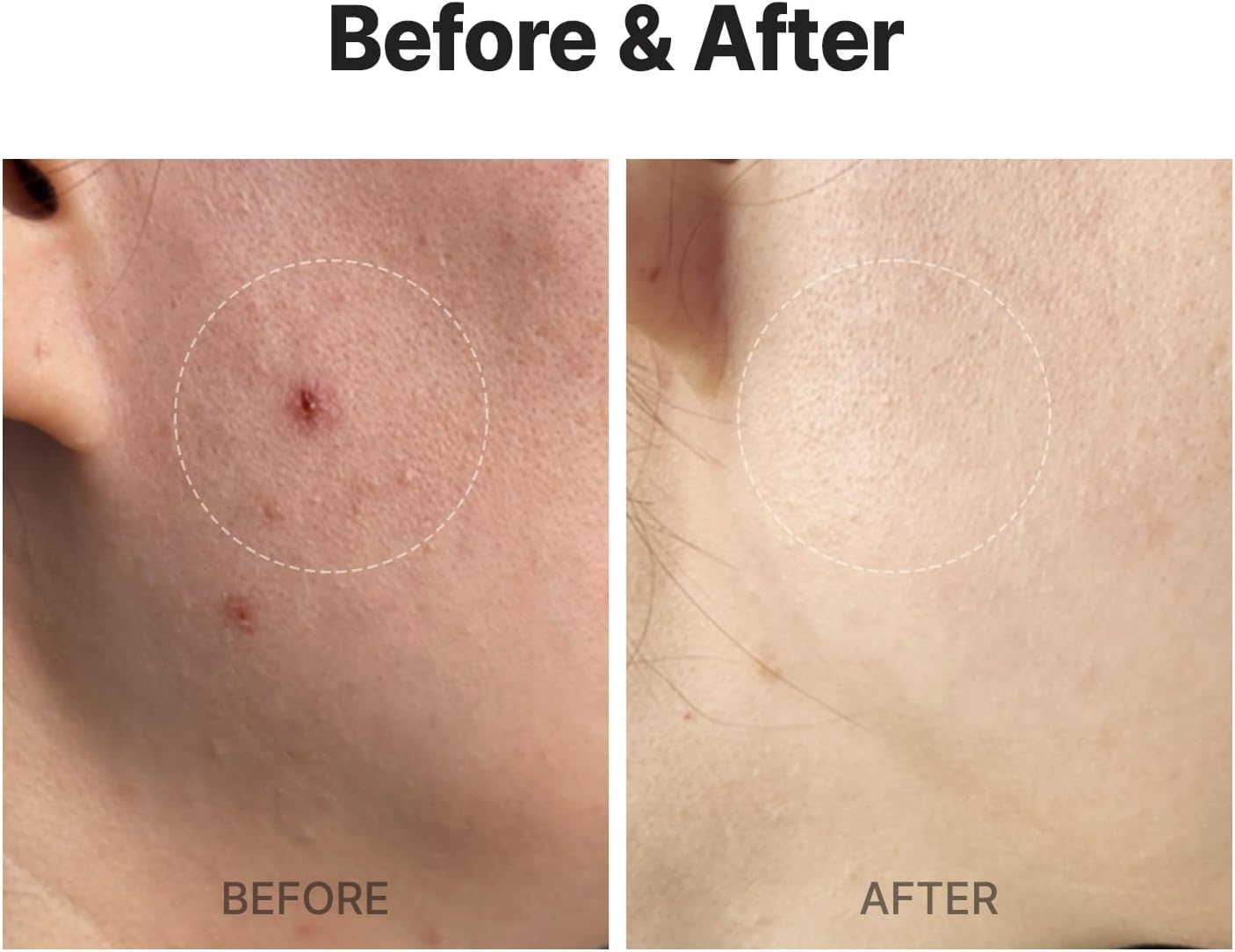 MEDITHERAPY A Clearing Toner Swab (1.57in Swabs + 0.33 fl.oz Toner), Pore Tightening Swab (7 Pouches), Soft Exfoliator for Acne-Prone Skin, Vegan, Korean Skincare