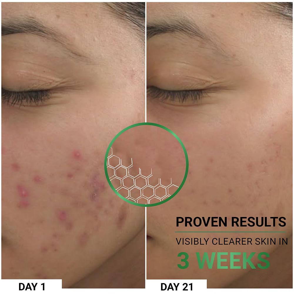 Sereko Clear Corrective Serum with 2% Encapsulated Salicylic Acid BHA & 3% Azelaic Acid | Active Acne | Reducing Sebum Production | Pigmentation & Dark Spots for Oily | Acne-Prone Skin 30ml - Pack 1 2