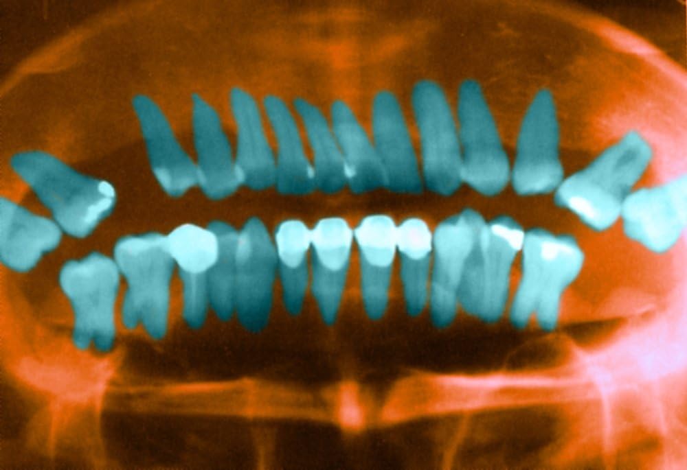 Panoramic Dental X-Ray Poster Print by Science Source (36 x 24)
