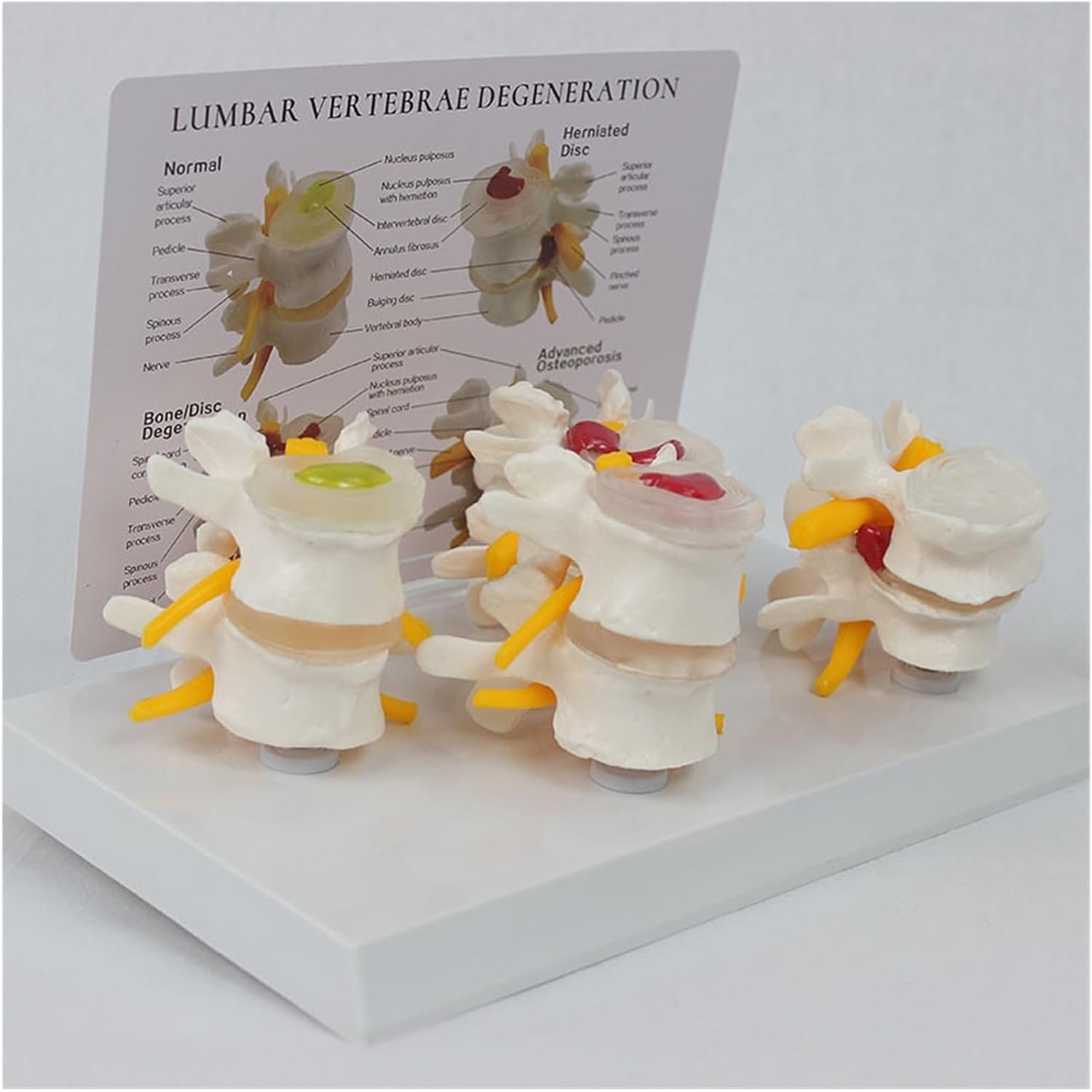 Modello di Vertebre a 4 Stadi, Modello di Ernia del Disco Intervertebrale di Scheletro Umano, Modello di Colonna Lombare Patologica, con Scheda Posteriore Inglese, per Studio Medico E Aule