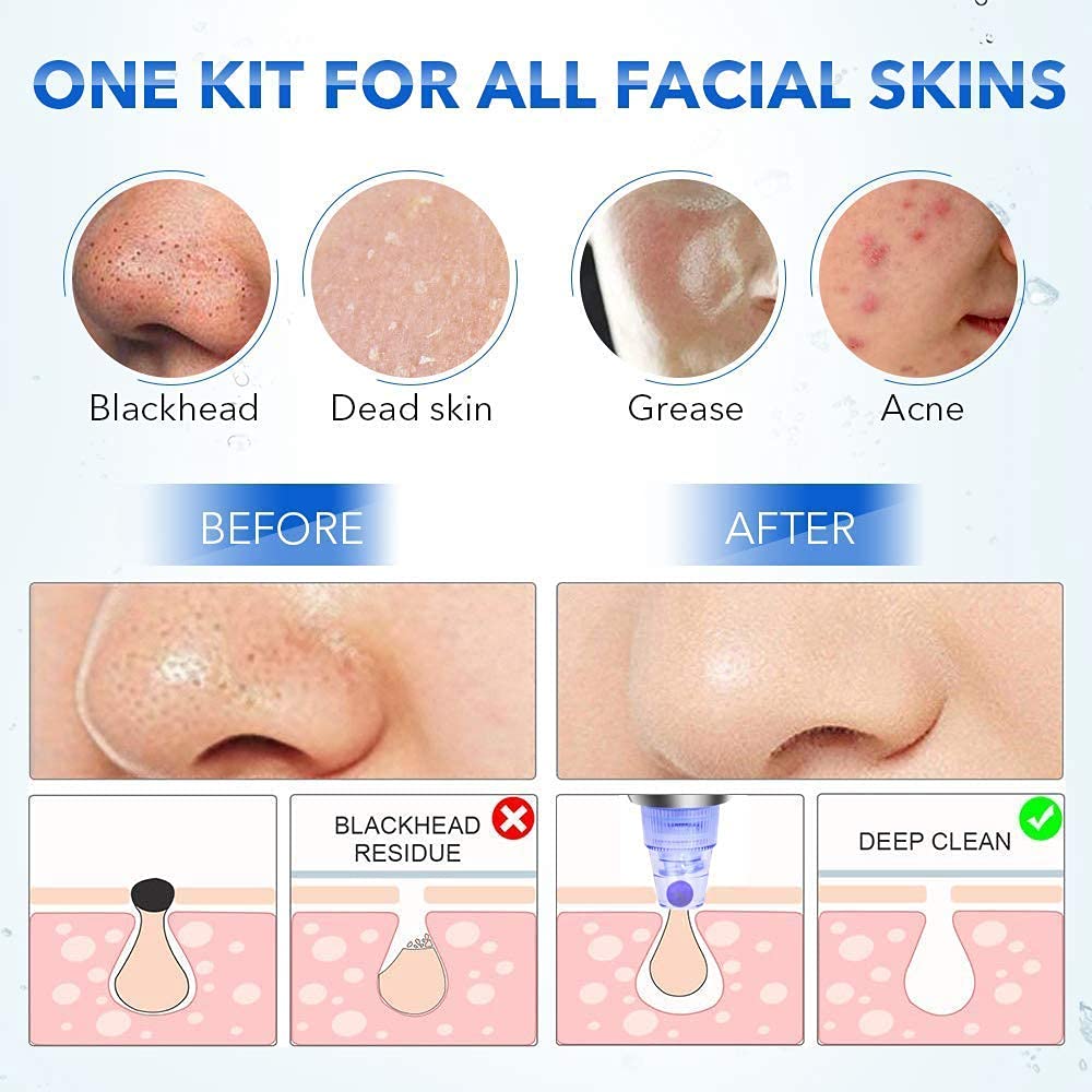 Vyoma Beautiful Skin Care Expert Acne Pore Cleaner Vacuum Blackhead Remover Kit Skin Cleaner, Pimple Removal Tool, Acne Removal Tool, Click N' Play Girl's Pretend (Blue Darma) (A1) 3
