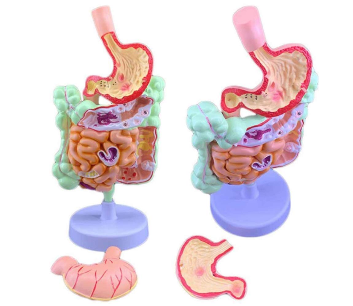 RRGJ Teaching Model, Colonic Pathology Model, Human Digestive System Model, Gastrointestinal Colonic Lesion Intestinal Disease Anatomy Model for Medical Training Teaching Aid Anatomy Biology