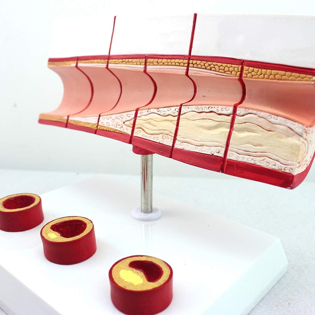 Model miażdżycy tętnic, model miażdżycy ludzkiej sercowo-naczyniowej, model anatomiczny, medyczny materiał edukacyjny, 10-krotny