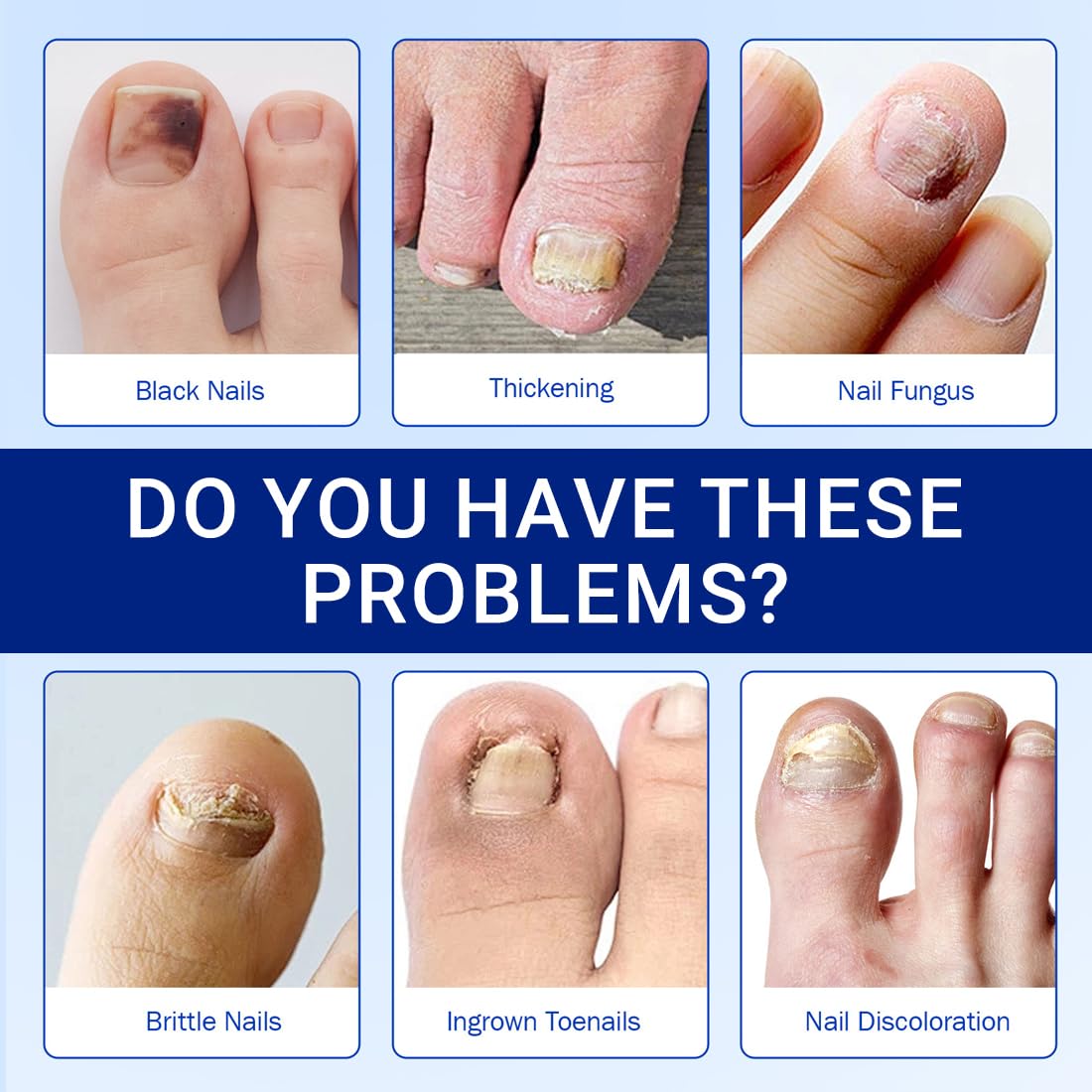 GXGM 42 Pezzi Fungal Nail Patches, Toppe Fungine per Unghie, Toppe per Unghie Fungo, Cerotti Multiuso per la Riparazione Delle Unghie dei Piedi Danneggiate Delle Unghie Scolorite