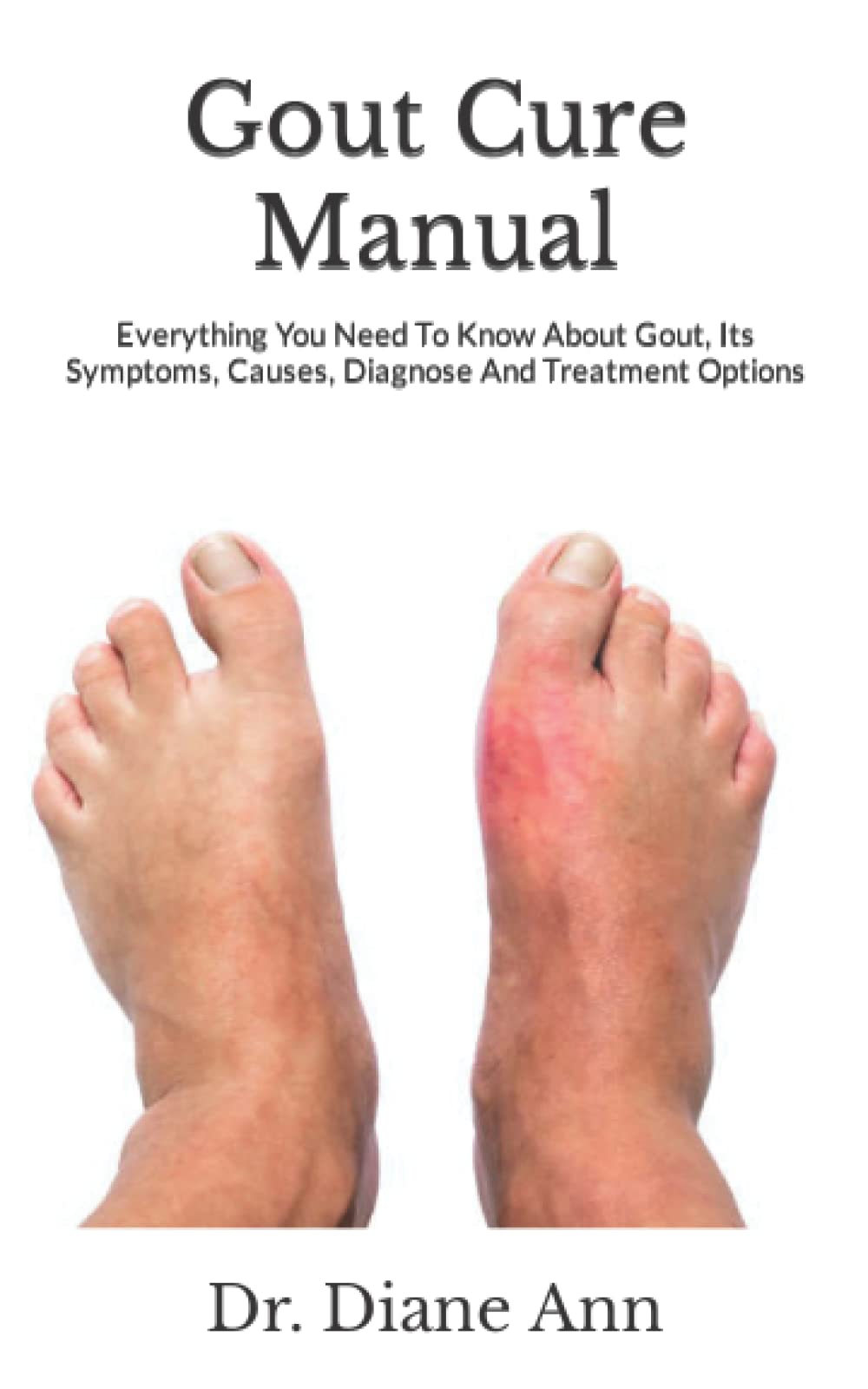 Buy Gout Cure Manual: Everything You Need To Know About Gout, Its ...
