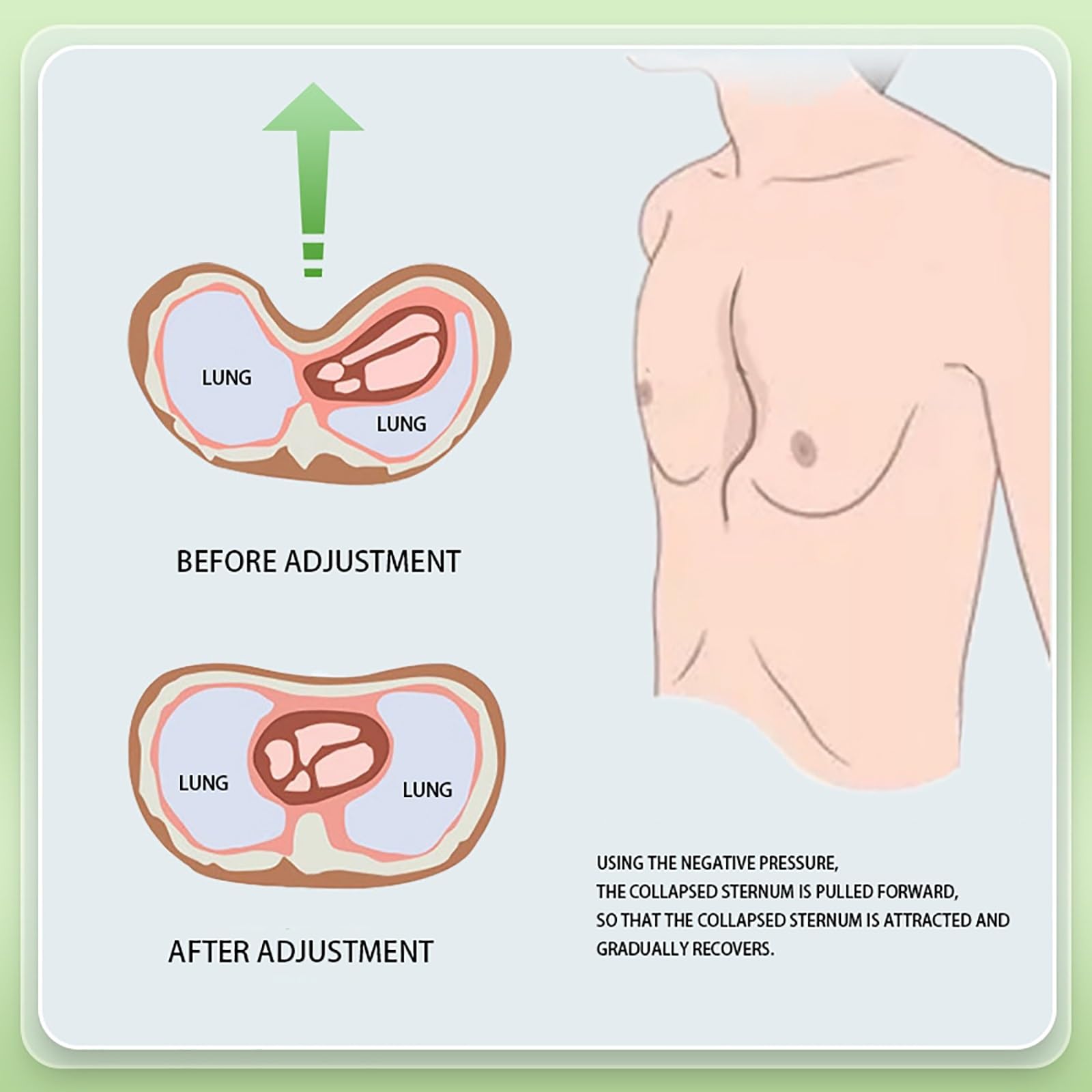 Amazon.co.jp: 漏斗胸バキュームベル - 大人用漏斗胸装具