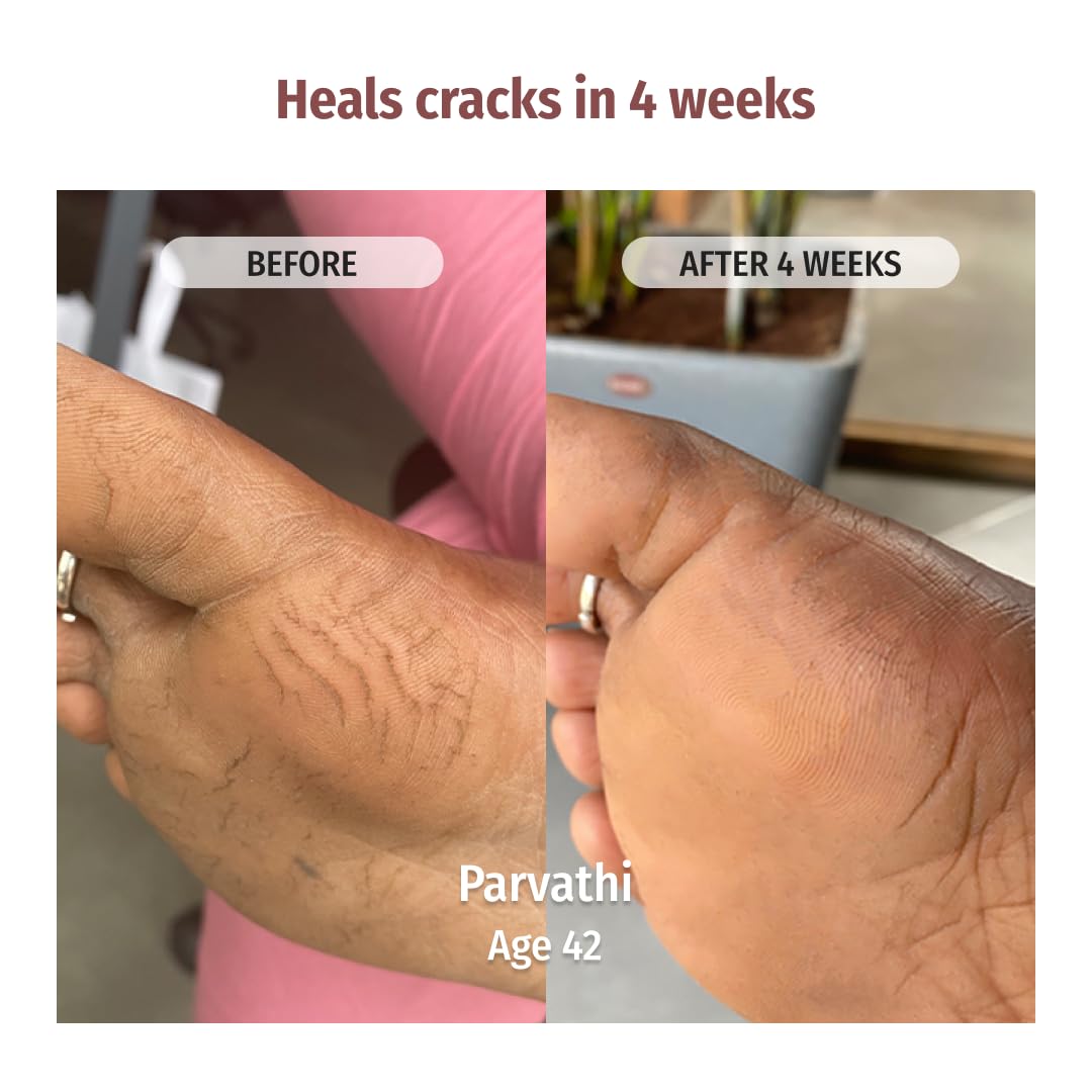 Vilvah Foot Cream for Cracked Heels | Repairs Dry, Rough & Damaged Feet | Softens Calluses & Removes Dead Skin | Deep Hydration & Odour Control | 100ml 1