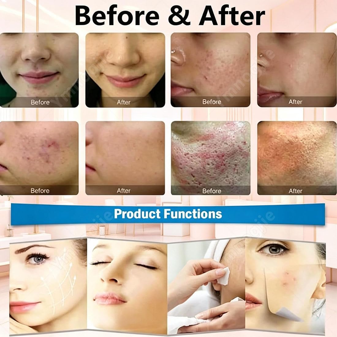 Gold Microneedling Geräte für Schönheitssalons Werden Standardmäßig Mit 4 Nadeln Geliefert