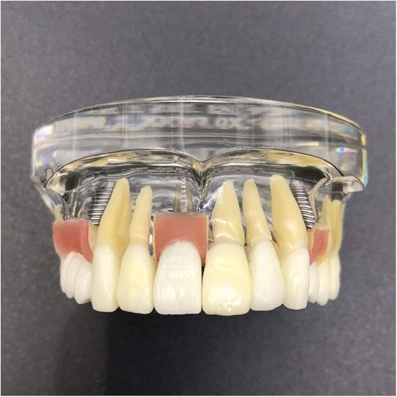 Maxillary Implant Study Analysis Demonstration Teeth Model - Dental Implant Model - with Removable Teeth and Soft Gum