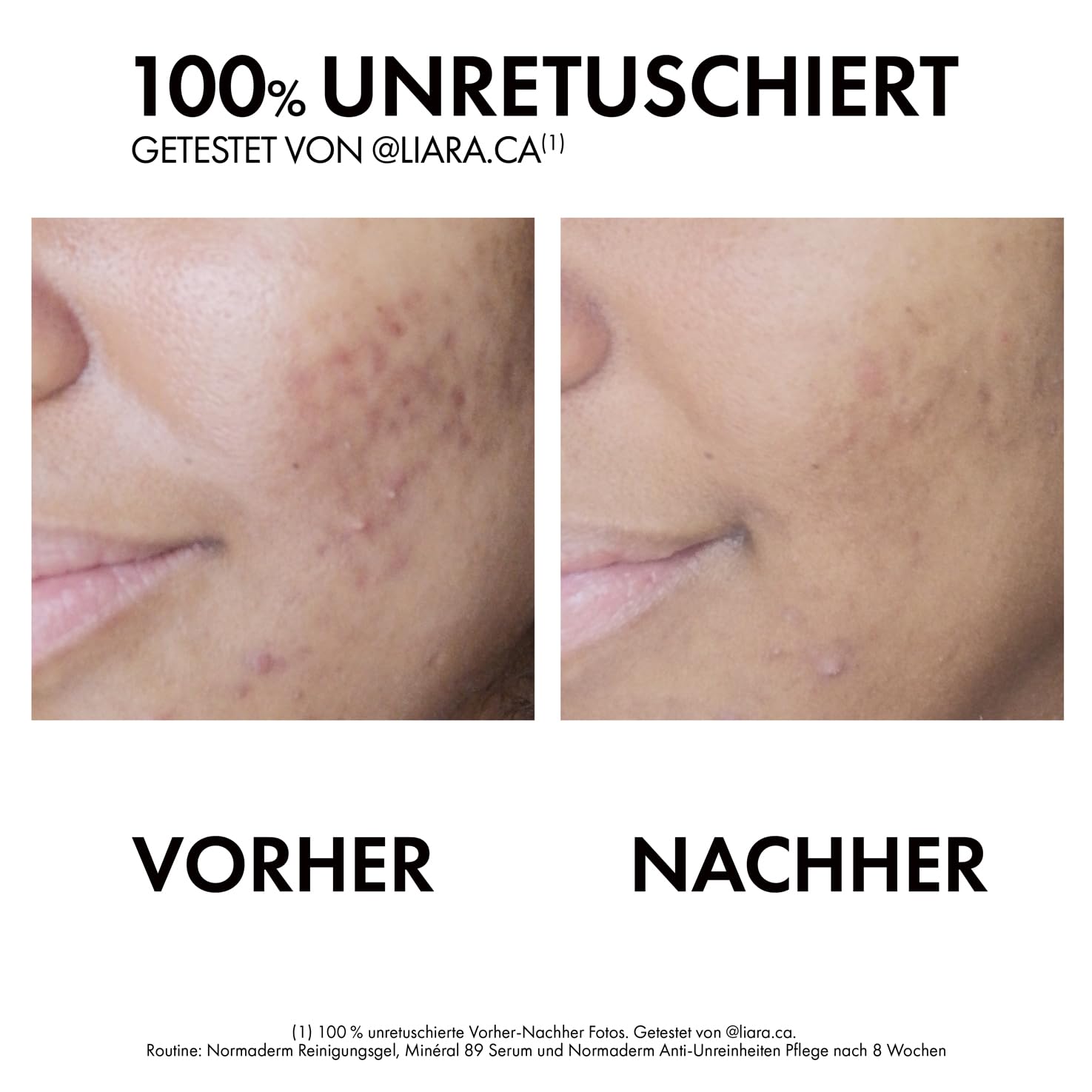 VICHY Sensitive Anti-Unreinheiten-Pflege, Für fettige, zu Akne neigende Haut, Mattierend und Regenerierend, Mit Hyaluron- und Salicylsäure, Normaderm Phytosolution, 50 ml