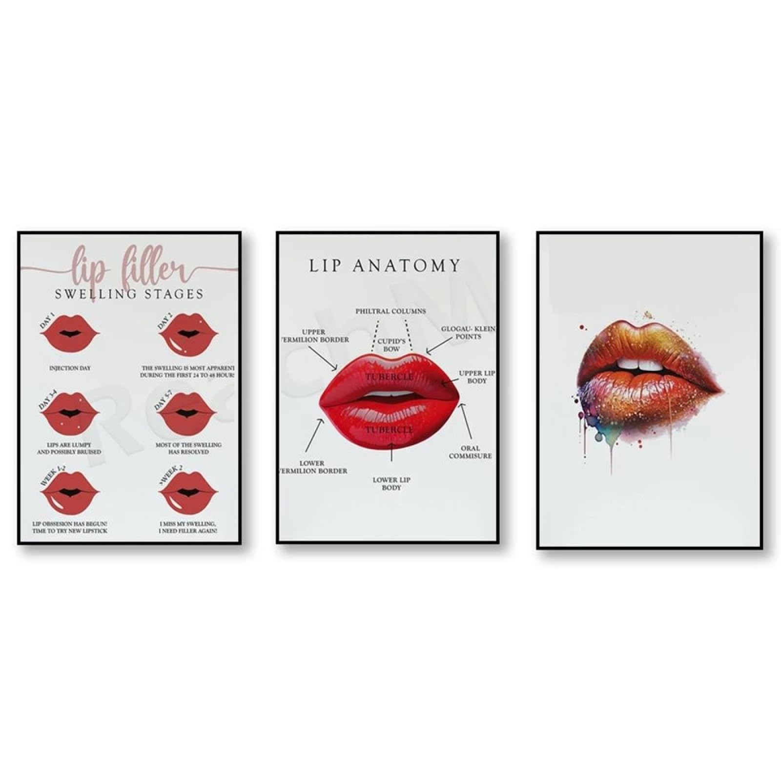 Baibexing Lip Anatomy, Lip Syringe, Lip Filler Print, Med Spa Decoration, Lip Print, Lip Enhancement, Lip Redness Fix, Beauty Salon Poster 21X30Cmx3Pcs Unframed
