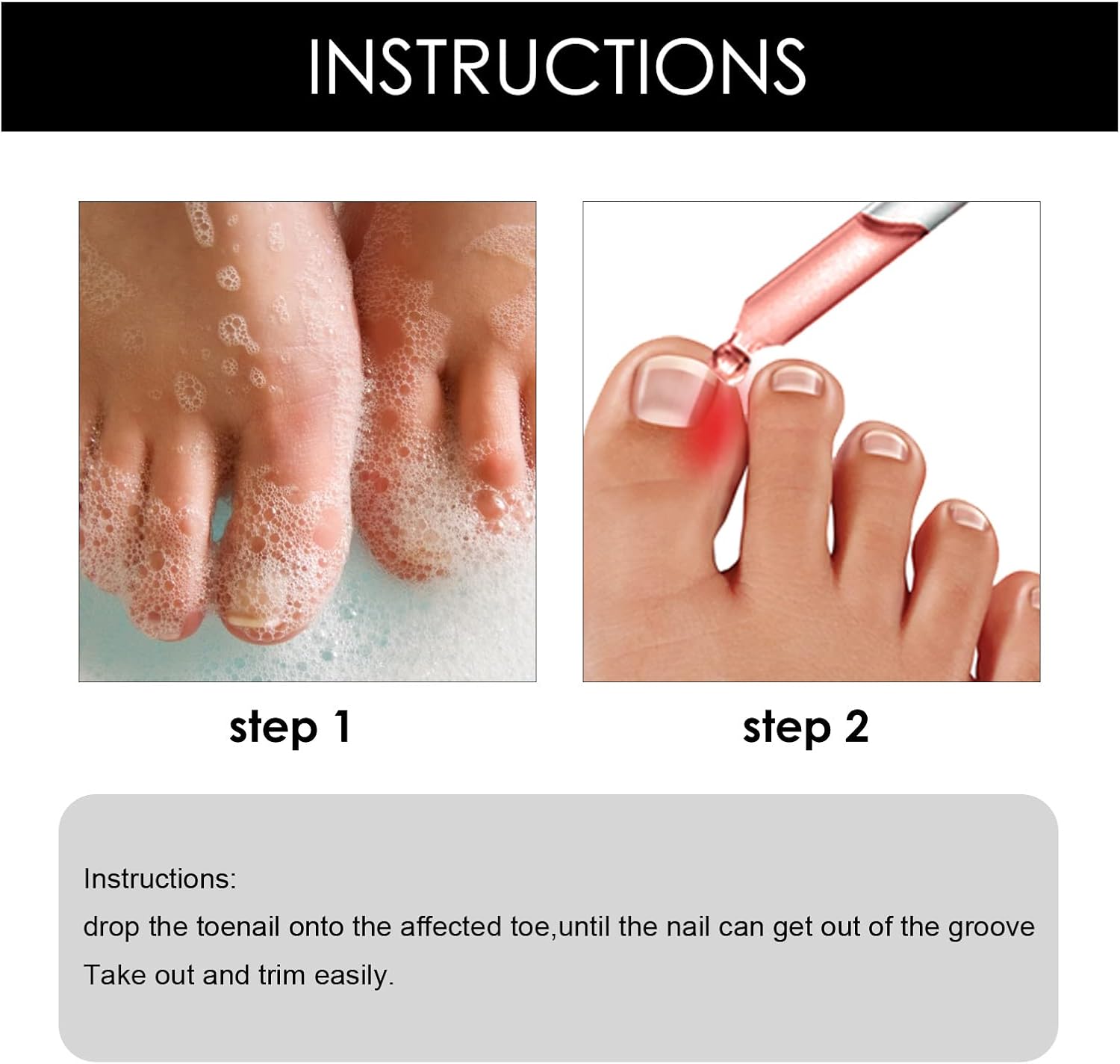 XIRUJNFD Nail Helper Ingrown Toenail Drops, Best Ingrown Toenail Treatment, Ingrown Toenail Pain, Outgrow for Ingrown Toenails (1pcs) : Beauty & Personal Care