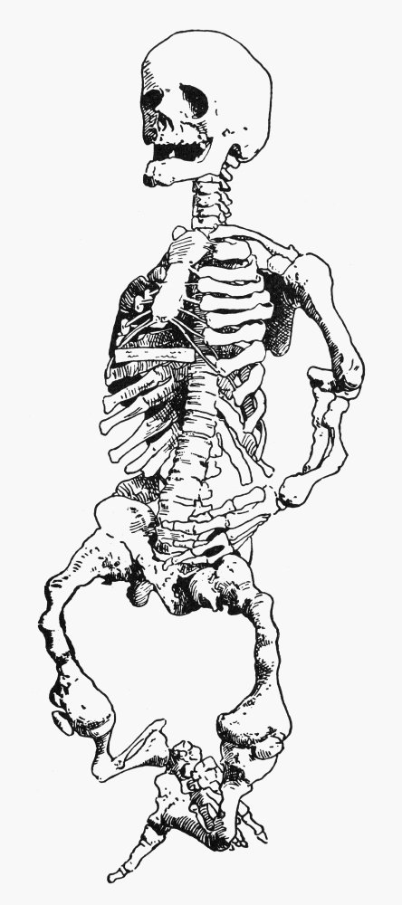 Rickets Nextreme Deformity Of The Skeleton Of A 21 Year-Old Native American Due To Rickets Showing Enlargement Of The End Of The Bones Poster Print by (24 x 36)