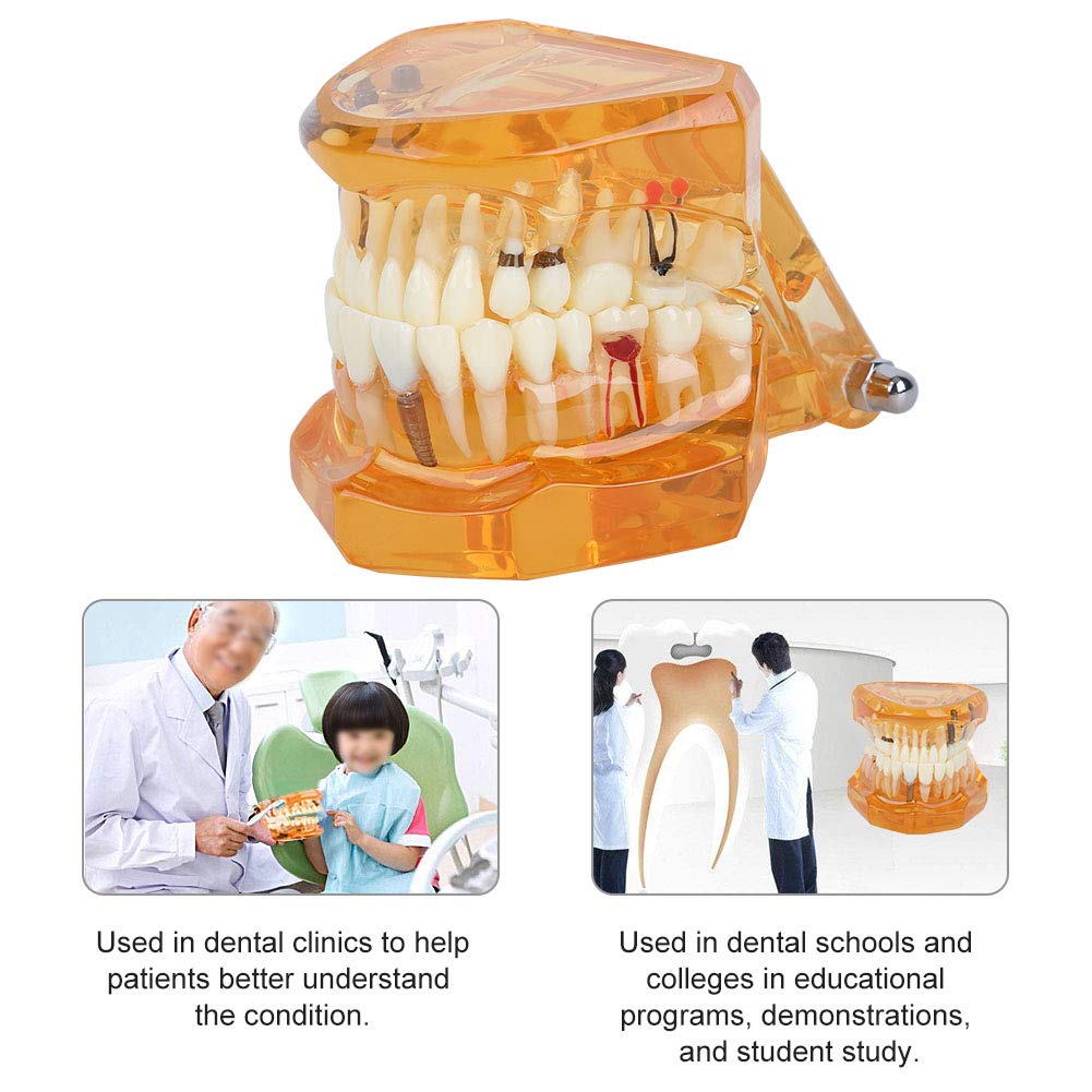 Modelo de Dientes para Demostración de Enfermedades Dentales Extraíble, Educativo Anatómico Profesional para Enseñanza Dental