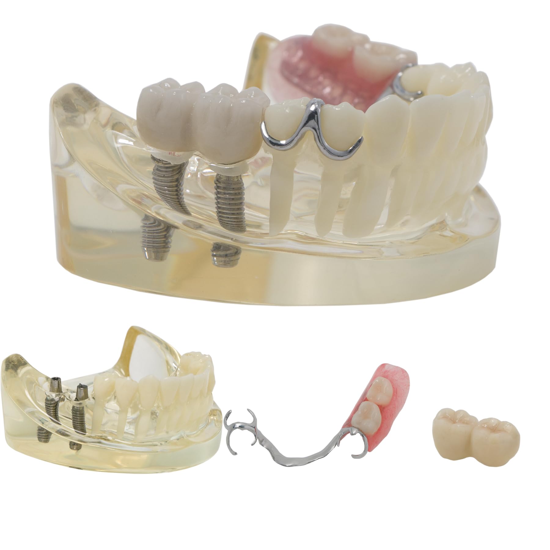 Dental RPD Removable Partial dentures Model Typodont lmplant Model