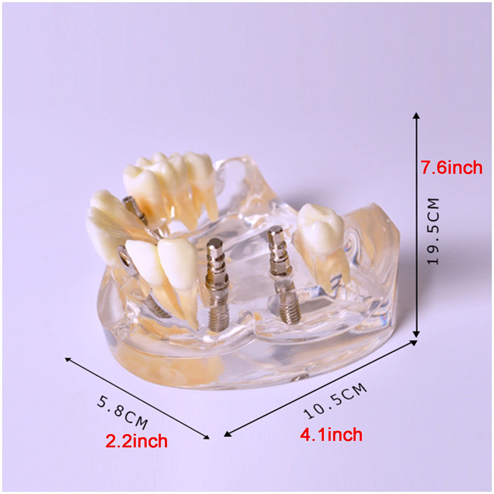 Modèle D'implant De Dents - Modèle De Restauration Supérieure De La Surventure De L'implant Dentaire - Modèle D'étude des Dents Dentaire avec Pilier, Ongle D'implant, Gomme Douce