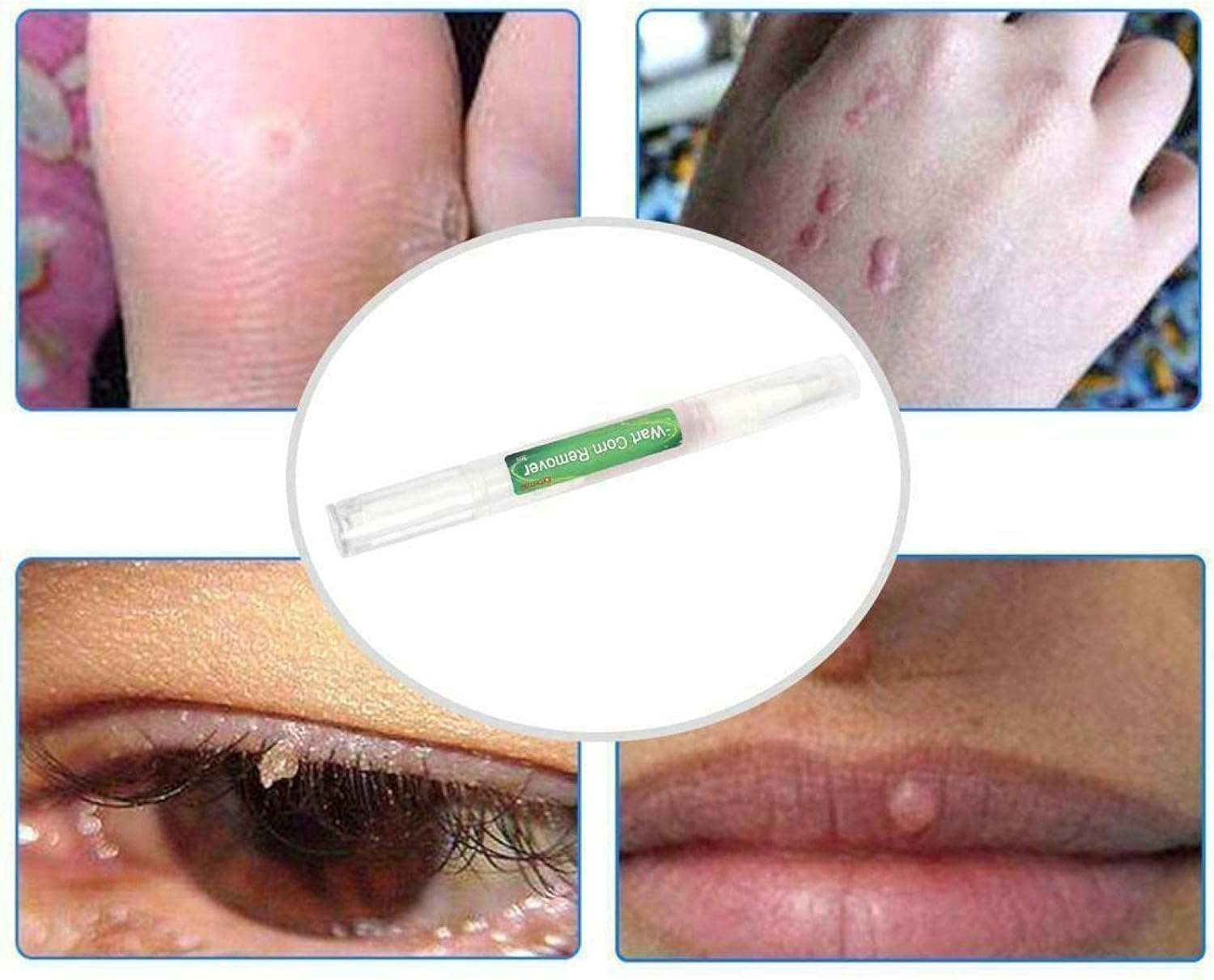5Pcs Genital Wart ​Treatment Papillomas Removal Warts Liquid Remove Fast Effective Wart Remover Pen 3ml