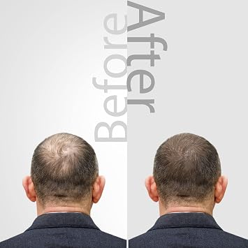 The Mossi London Ozonized Scalp Oil - Hair Growth with Argan, Jojoba & Vitamin C - Dry Scalp Treatment for Thicker-Looking Hair - Ozone Oil for Men & Women, 30ml