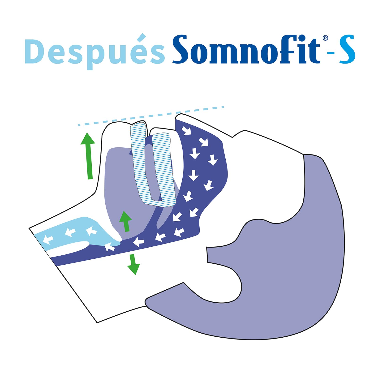 Somnofit-S - Férula dental - Antirronquidos - Solución para la apnea - Solución para el ronquido - Dispositivo de avance mandibular