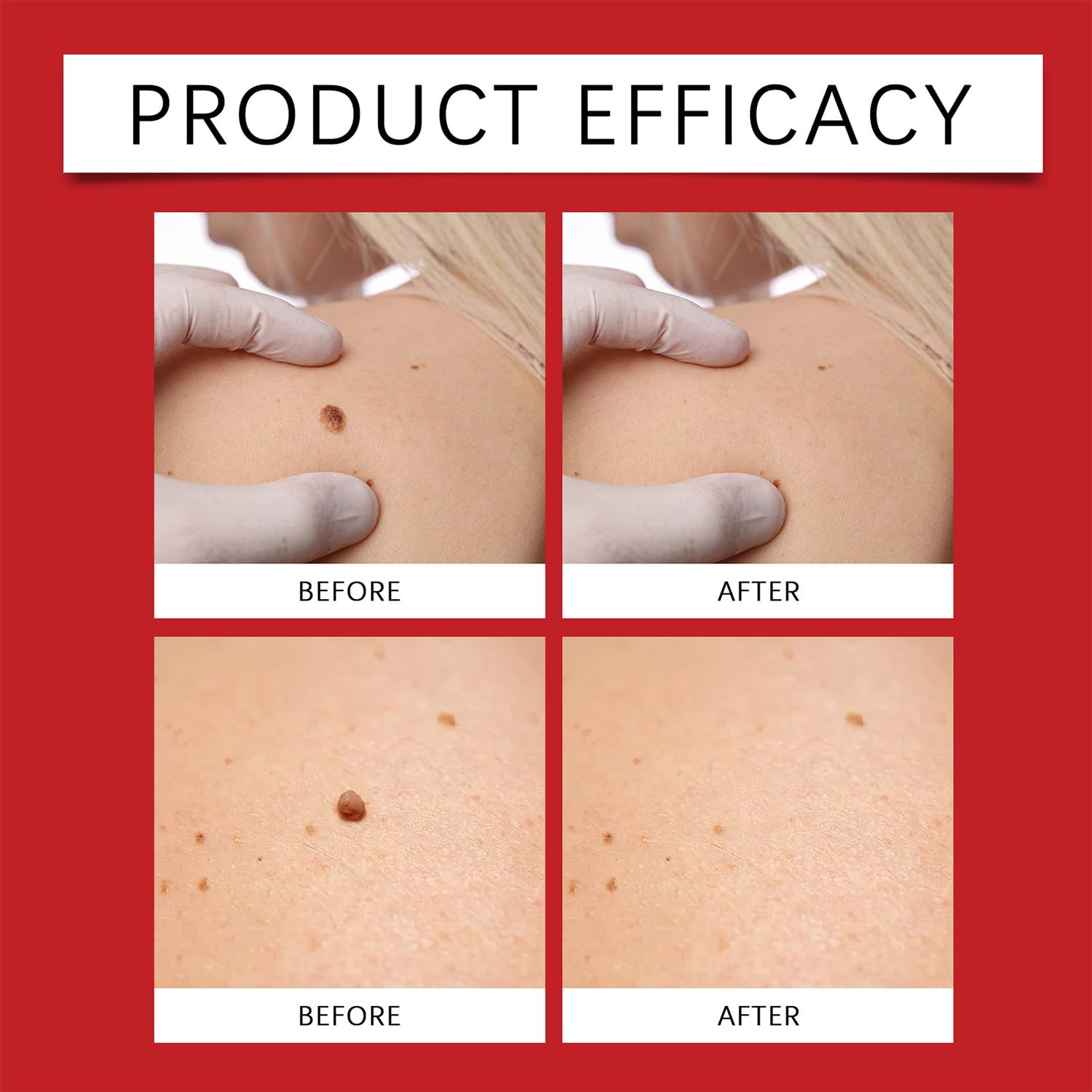 Skin Tag Removal Patches, Skin Tag Remover, Rimozione di Talpe, Acne Patch, Rimozione di Verruche, Patch per la Riparazione e Trattamento Della Pelle, Per uomini e donne 81Pezzi