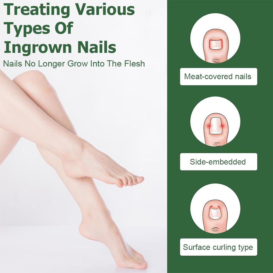 80 Piezas Korrección de Uñas Encarnadas, Parche Corrector de Uñas de los Pies,Parche de Corrección de Uña Encarnada Elástico, Pegatinas de Uñas Encarnadas, para Mujeres y Hombres