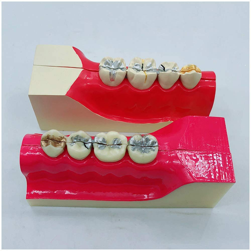 Sjdopulse A Dental Molar Cross Section Teeth Model - Simulation Oral Tooth - Dental Teeth Study Teaching Model - Dental Nerve Line Model Of Right Lower Posterior Tooth Tissue Decomposition (A)