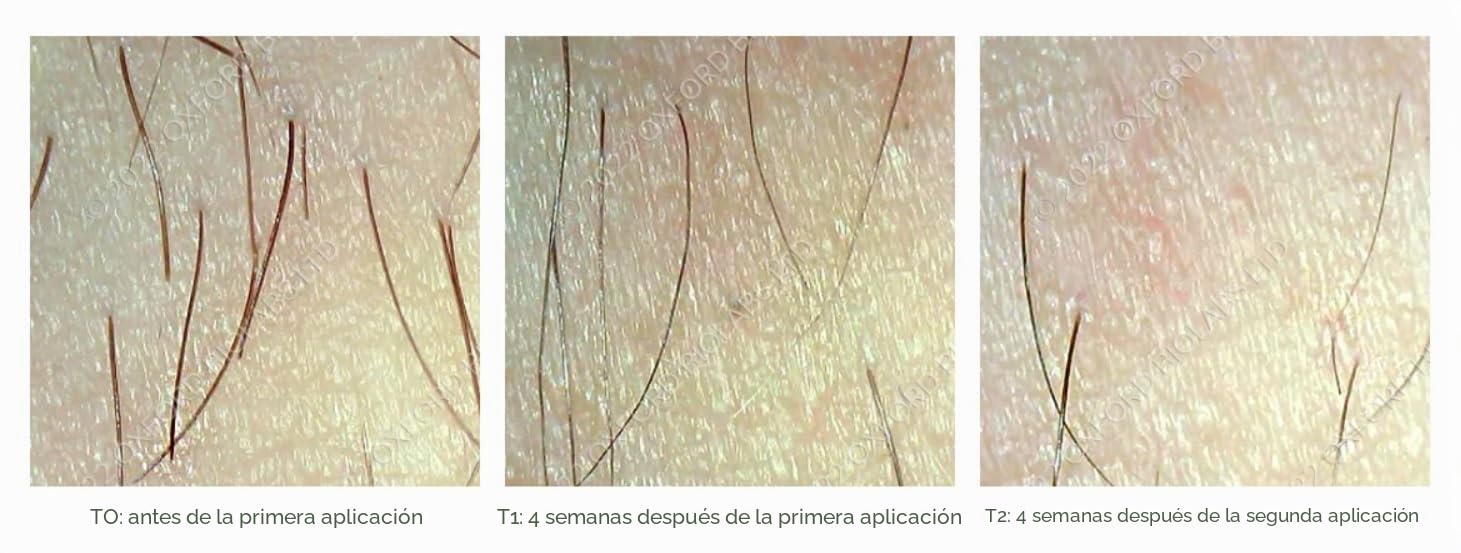 Hair Inhibition System – Hair inhibitor - Non-Irritating Hair Removal Lotion - painless hair removal after epilation, waxing - Nourishes the skin – For any skin and hair type