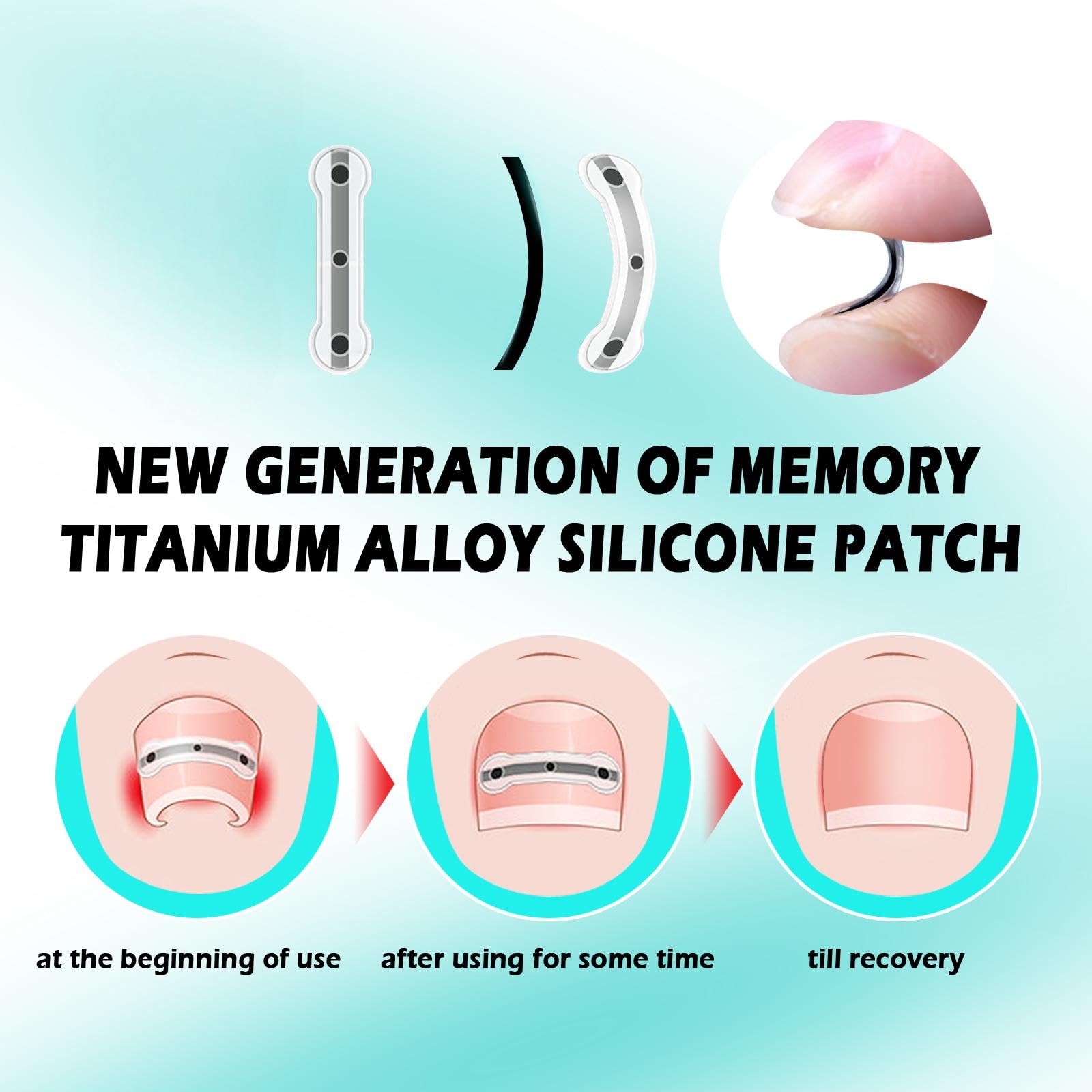 Titanium Alloy Silicone Ingrown Correction Patch Tool,Ingrown Toenail Treatment,Ingrown Toenail Removal Kit,Designed for Curved Nail Repair, nail Corrector,Cuttable Suitable to most sizes,reusable