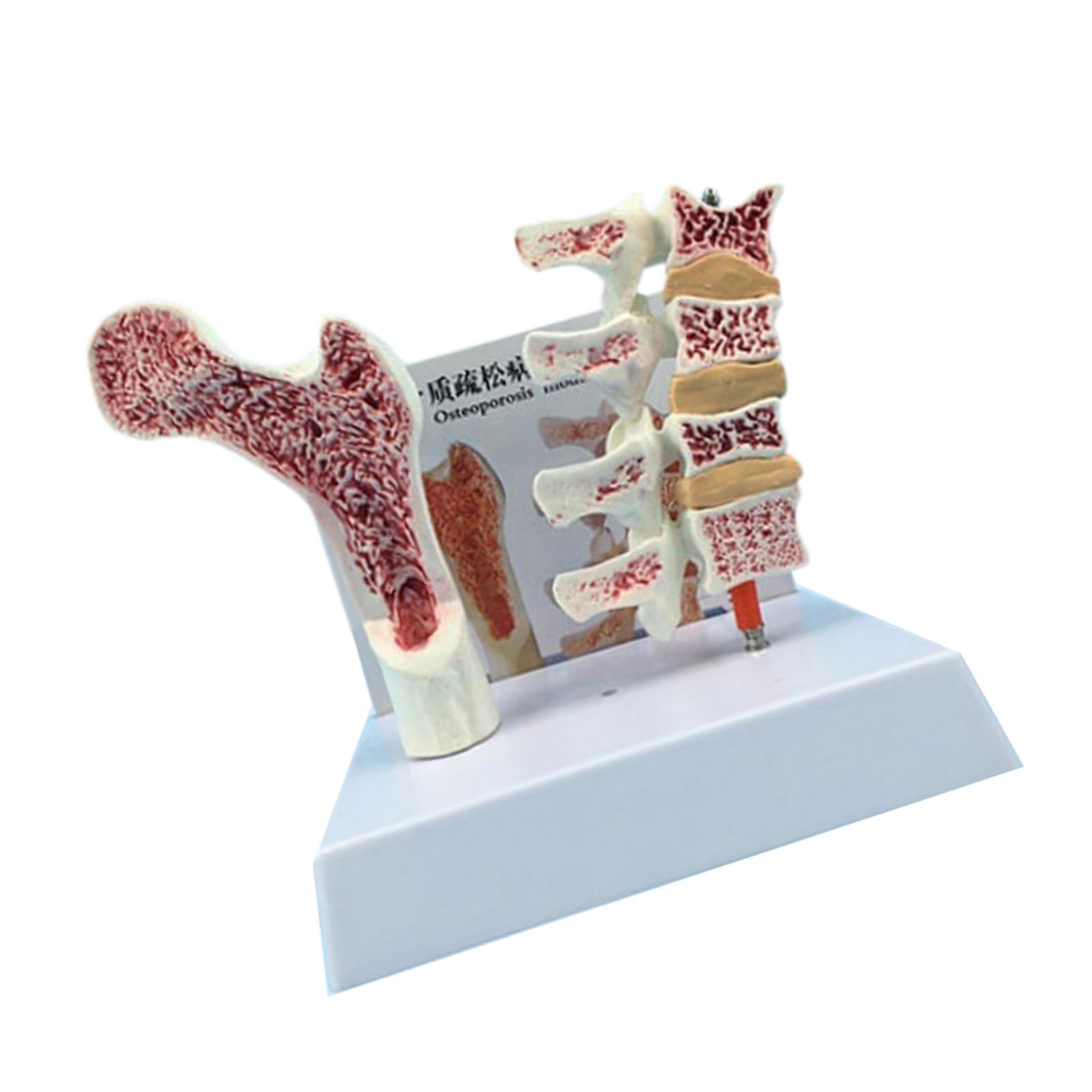 RBRMHM Human Anatomy Osteoporosia Model Educational Model Vertebrae Anatomical Skeleton Model Medicals Teaching Tool for Study