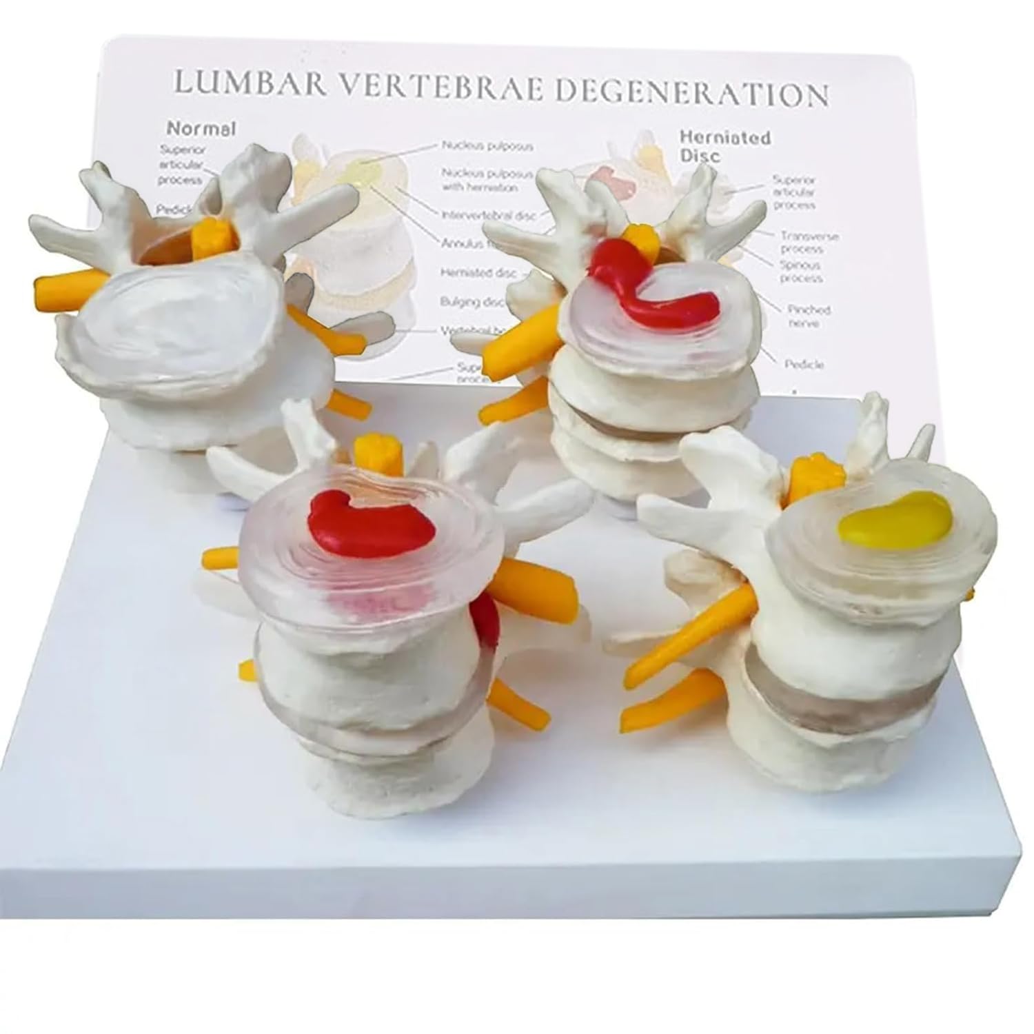 Modello di Vertebre a 4 Stadi, Modello di Ernia del Disco Intervertebrale di Scheletro Umano, Modello di Colonna Lombare Patologica, con Scheda Posteriore Inglese, per Studio Medico E Aule