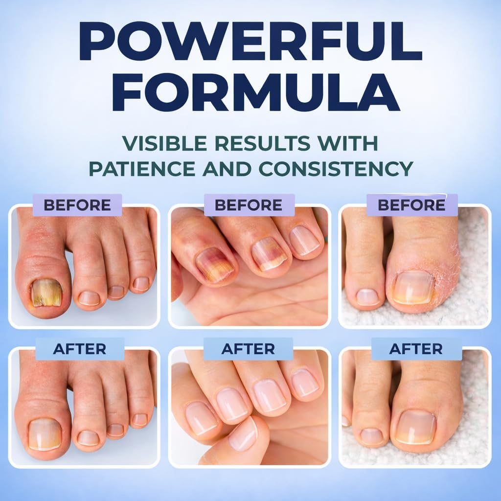 FSA Eligible HSA Extra Strength Athlete‘s Foot & Toenail Fungus Treatment Pen – Maximum OTC Antifungal with 25% Undecylenic Acid, Precision Applicator for Itch Relief & Nail Care