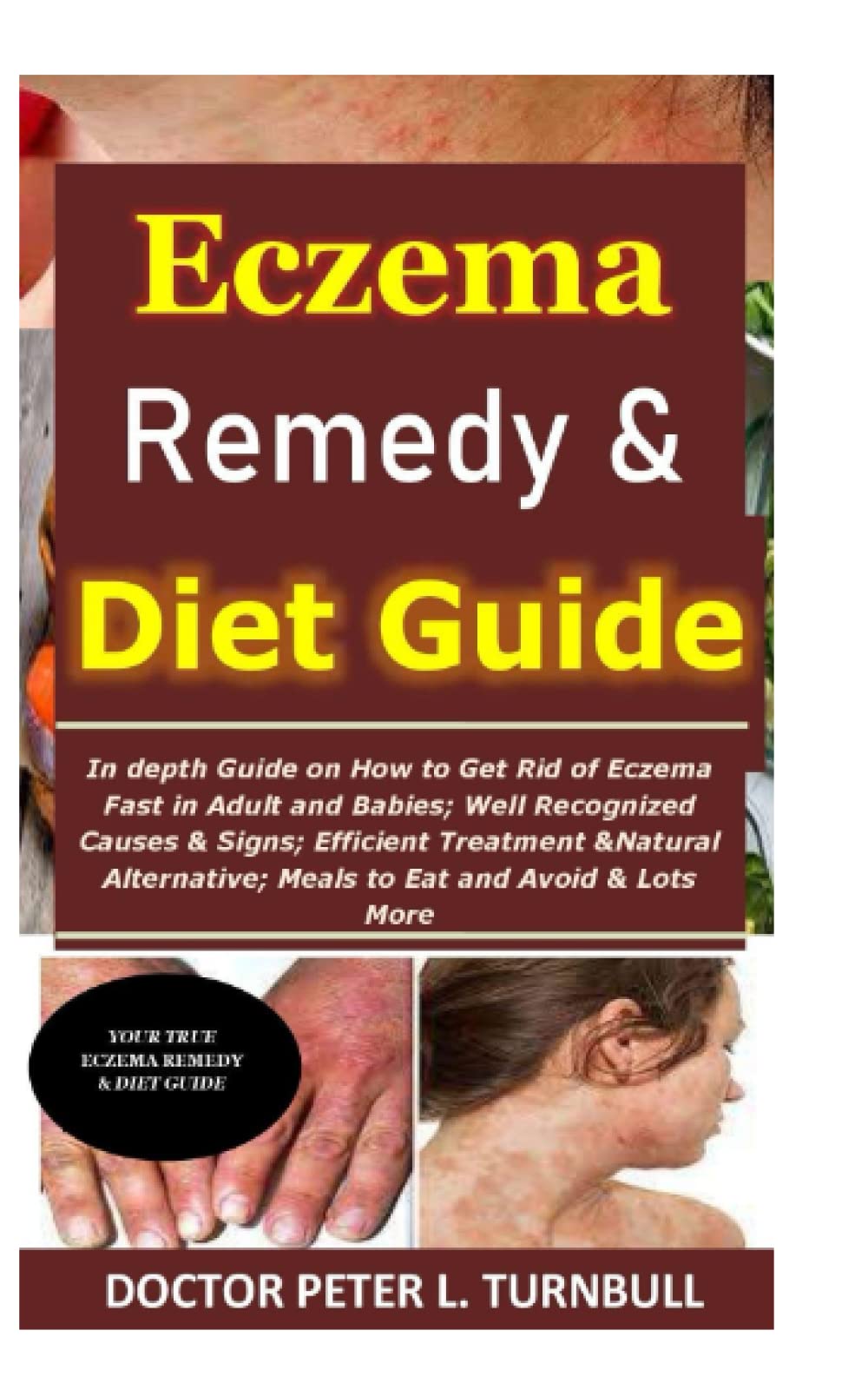 Buy Eczema Remedy & Diet Guide In depth Guide on How to Get Rid of