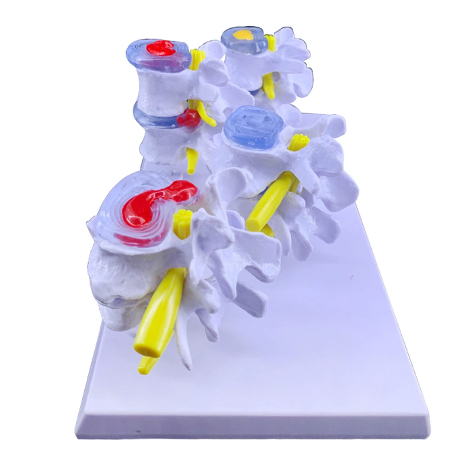 4 etap Model anatomiczny ludzki uszkodzenie kręgosłupa lędźwiowego statua kręgosłupa osteoporoza Model medyczny model chory narzędzie do nauczania