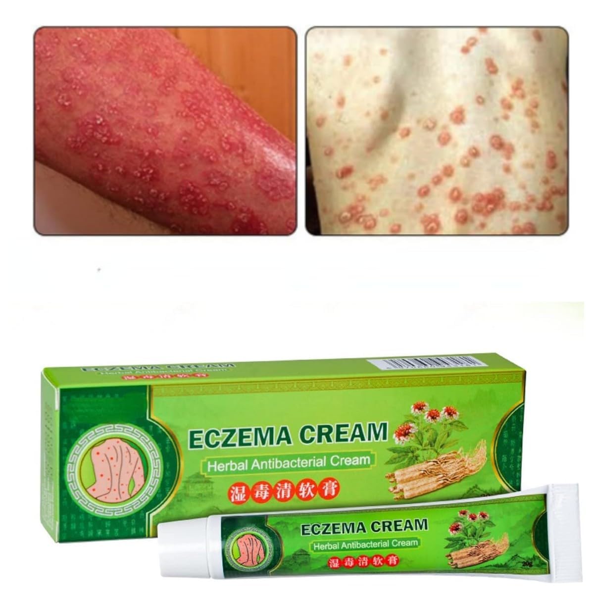 Rhomba 1 Pack Natural Herbal Eczema Pruritus Psoriasis Ointment，Psoriasis Creams - Psoriasis Treatment, Antibacterial Cream,for Body Itching