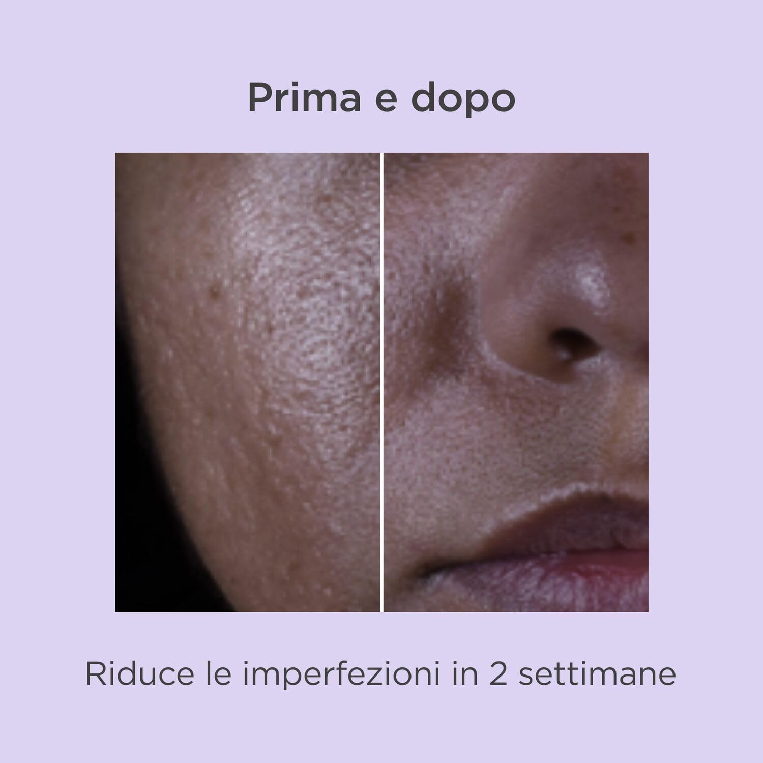 ISDIN Isdinceutics Salicylic Renewal (30 ml) | Siero Viso con Acido Salicilico, Aiuta a Ridurre Imperfezioni e Rughe | Anti-età | Assorbimento Rapido | Texture Leggera