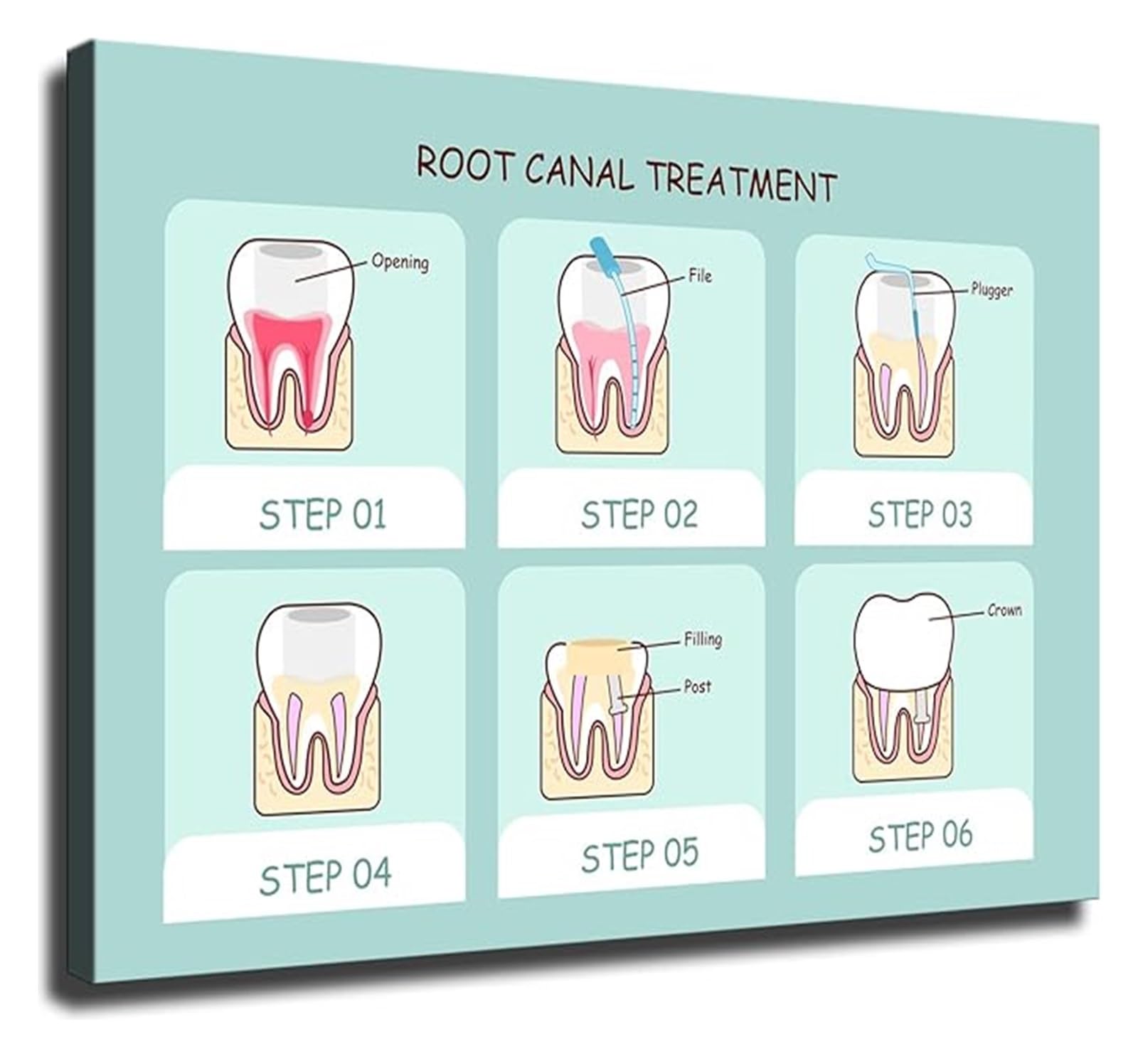 LLBOGRGGN Root Canal Guide Poster Oral Health Infographic for Clinic Patient Education(Unframed,08x12inch(20x30cm))