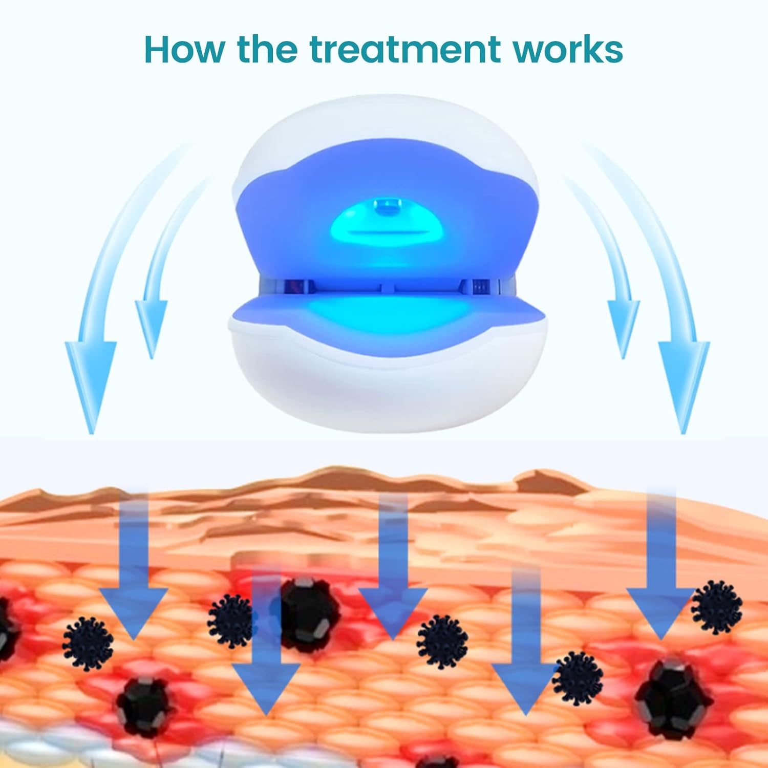 Nail Fungus Cleaning LaserDevice for Onychomycosis, Revolutionary Home Use Nail-fungus Remover, Upgraded Highly Effective Rechargeable Nail Fungus Treatment Device, Improving the Health of Unsightly Nails for Fingernails and Toenails (Upgrade Version Two Pieces) : Health & Household