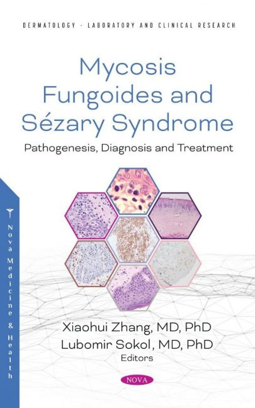 Mycosis Fungoides Causes, Diagnosis and Treatment Zhang, Xiaohui