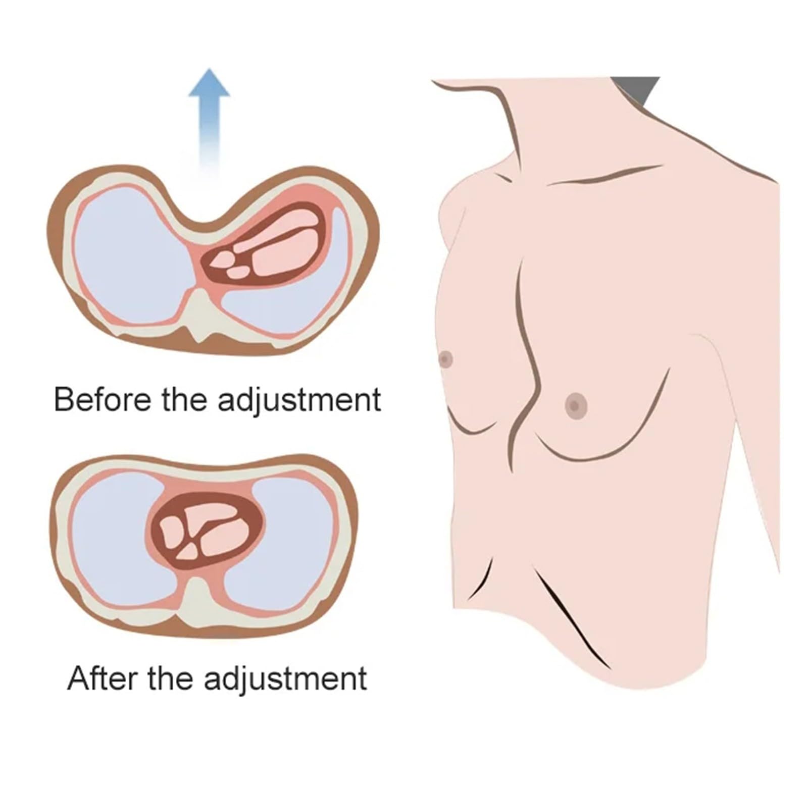 Pectus Excavatum Orteza Orteza Orteza Lejek Orteza Orteza Piersi, Orteza Ortezy Piersi, Orteza Depresji klatki piersiowej