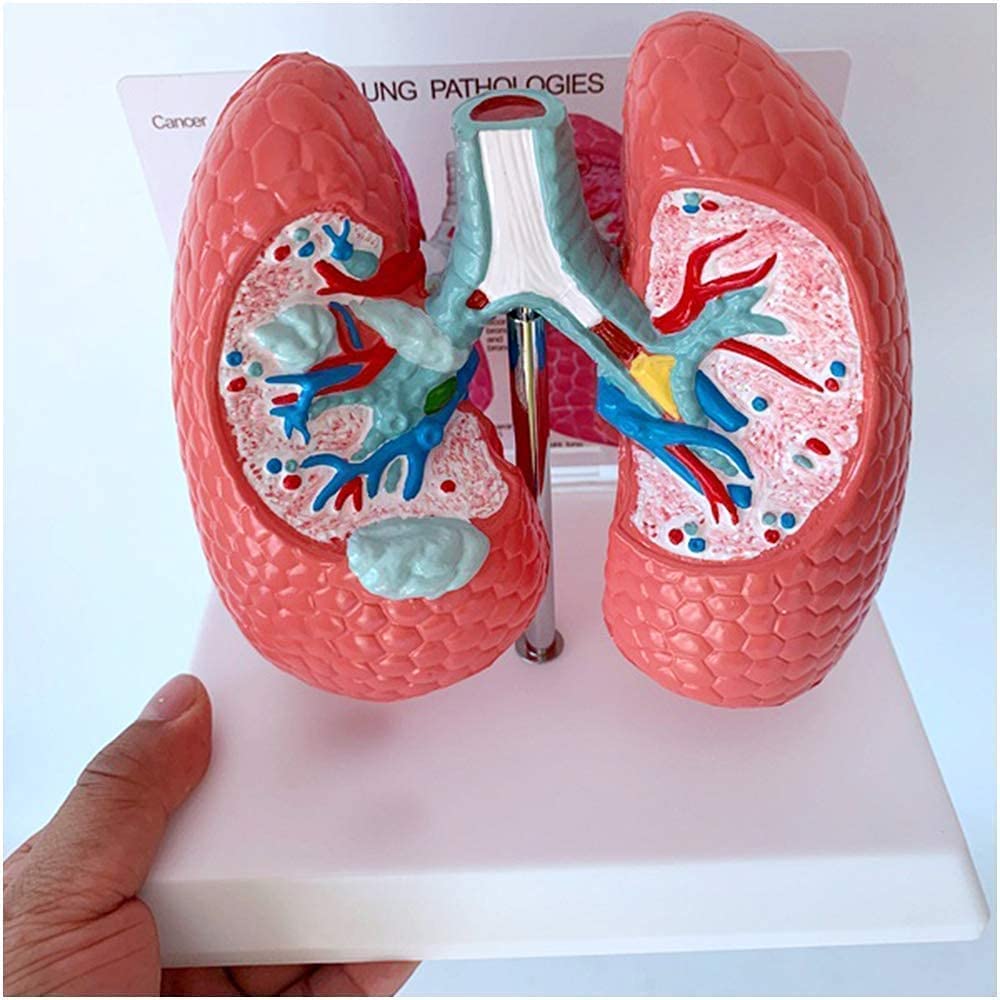 Study Model Lung Pathologies - Human Organ Anatomy Model Lung Disease Model - Respiratory Lung Healthy Lung and Pathology Comparison Demonstration Teaching Aid