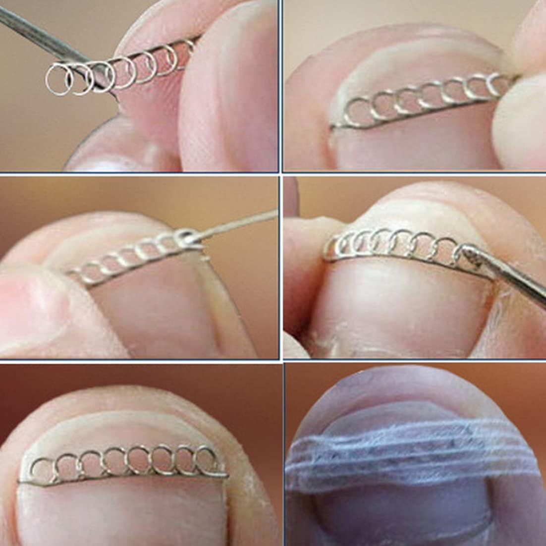 Toenail Correction Wire Ingrown Toe Pedicure Tool Stainless Steel Toe Nail Recovery Corrector 12PCS Beauty : Beauty & Personal Care