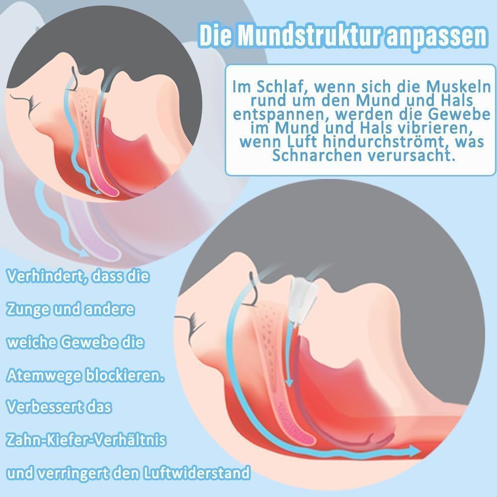 Anti Schnarch Schnarchstopper- Anti Snoring Schnarchschiene-2 Stück Effektiv Snoring Stopper gegen schnarchen Mehrzweck Schnarchen Verhindern für Männer und Frauen(Gebrauchsfertig-Blau)
