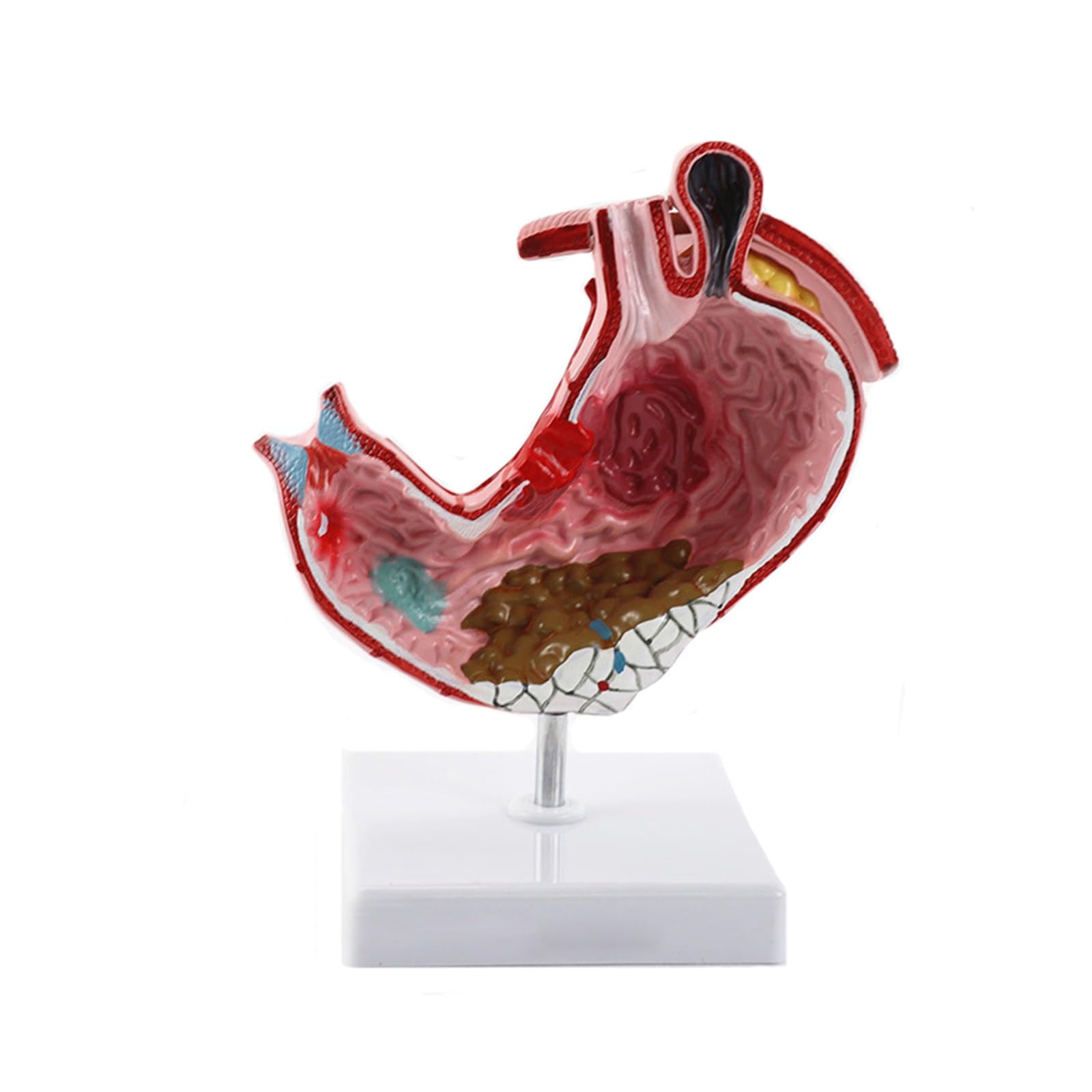 Humano EN Anatomía estomacal patológica Modelo de demostración del estómago Ayuda médica SIDA