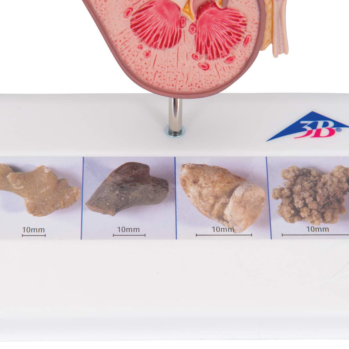 3B Scientific Anatomia ludzka - model z kamienia nerkowego + bezpłatne oprogramowanie anatomiczne - 3B Smart Anatomy, K29