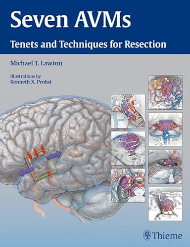 Seven AVMs: Tenets and Techniques for Resection