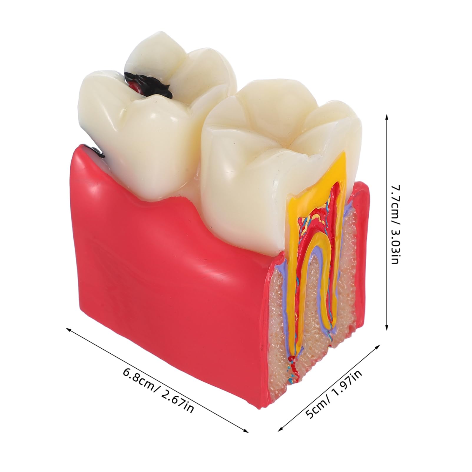 Alipis Modèle D'enseignement Comparatif de Carie Dentaire en Résine pour Dentiste Simulation Précise, Application Polyvalente pour L'éducation à Domicile et Scolaire