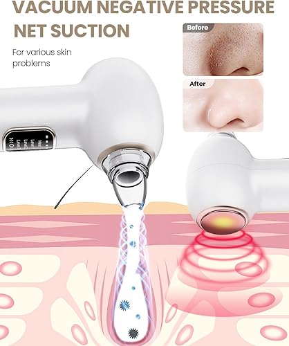 Miniatura 4 de Kit de eliminación de puntos negros al vacío de poros, 5 cabezales de succión y herramientas extractoras, 3 niveles de succión ajustables, limpieza