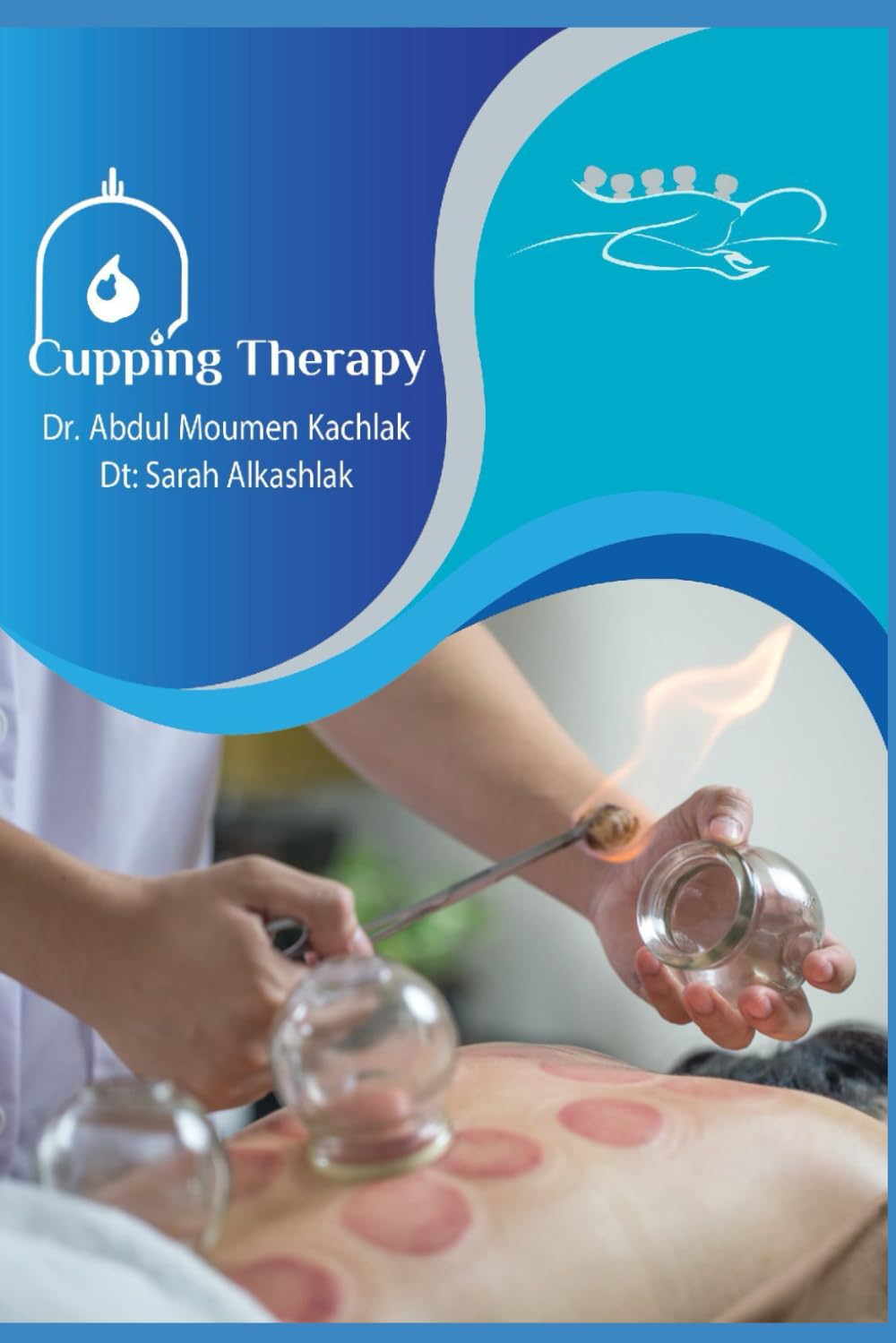 Cupping Therapy: Hijama